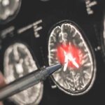 A hand pointing at a brain scan with highlighted areas